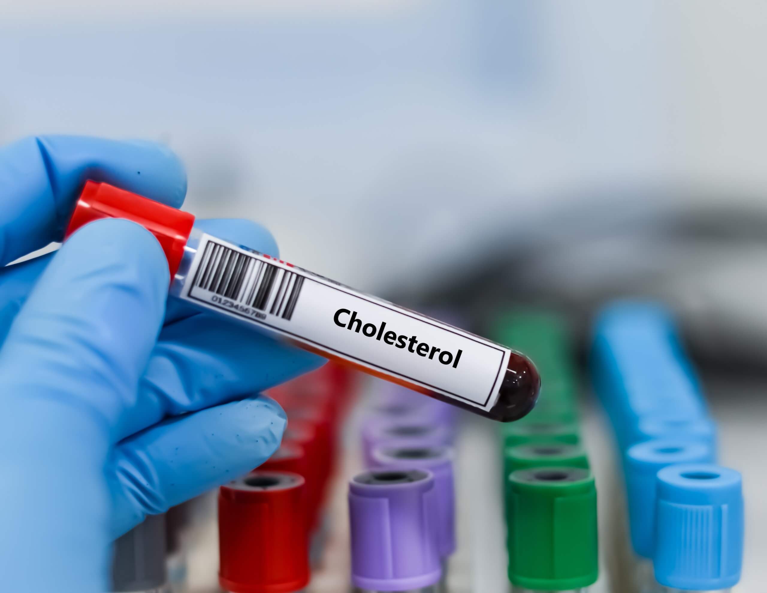 Ako na zvýšený cholesterol: Čo ho naozaj spôsobuje a ako ho znížiť
